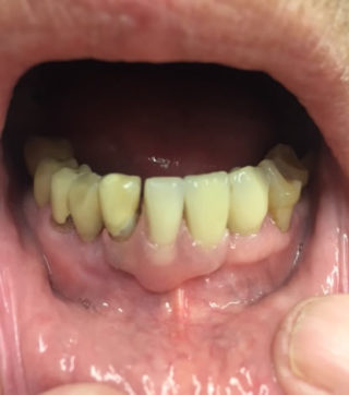 Before image of someones teeth