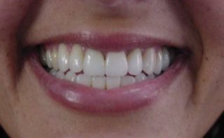 having new dentures Kevin Manners Denture Clinics