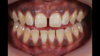 gum colour matching kevin manners denture clinics nottingham