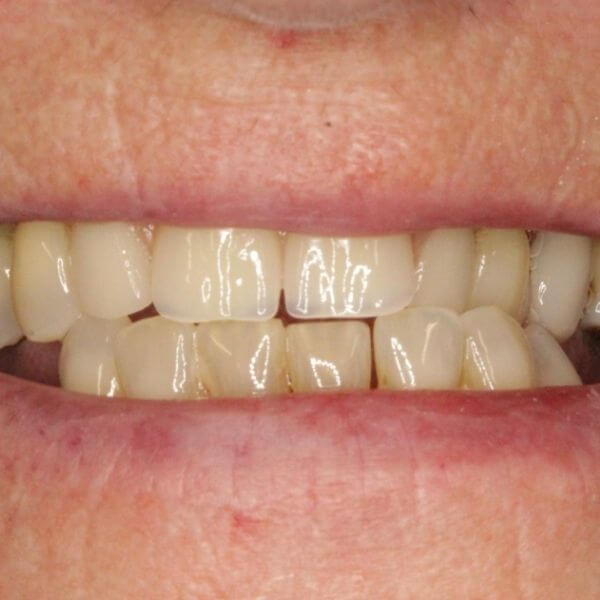 Chrome partial dentures