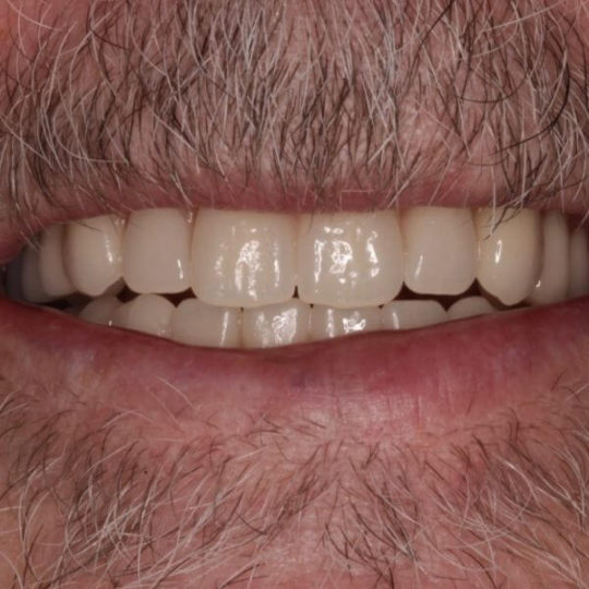 Before and After Dentures Kevin Manners Denture Clinics