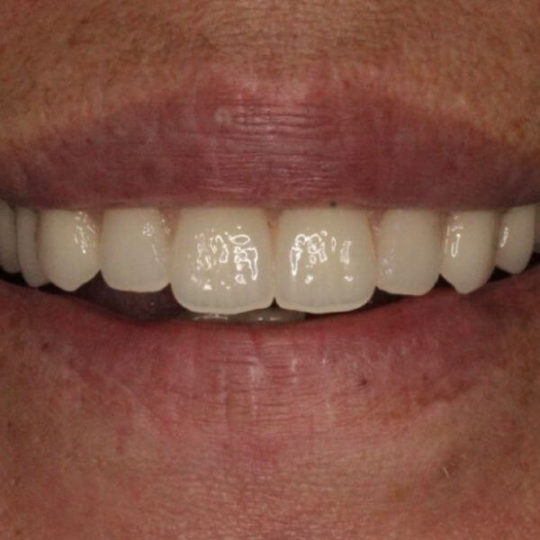 Before and After Dentures Kevin Manners Denture Clinics