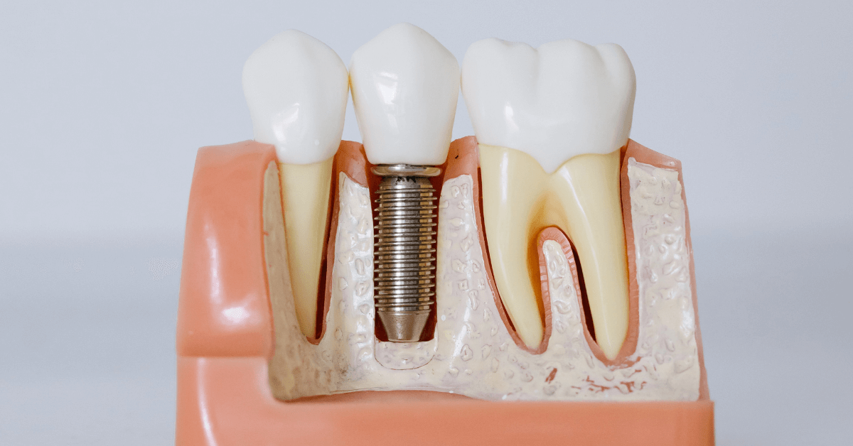 Section of a gum model showing a dental implant